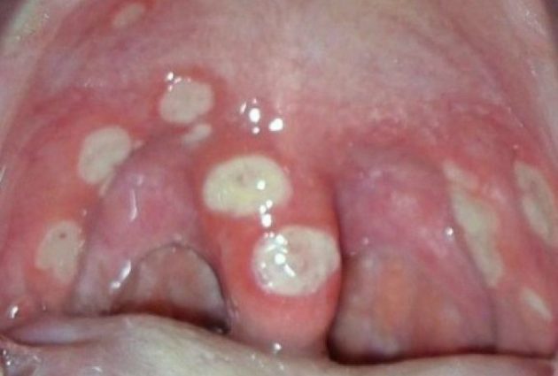 Симптомы грибка в горле