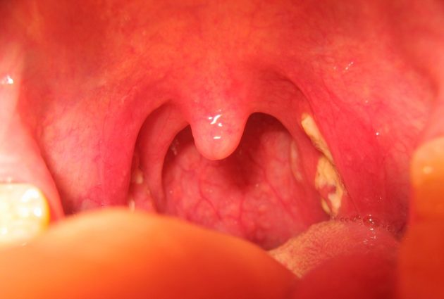 При ангине горло обычно болит с обеих сторон